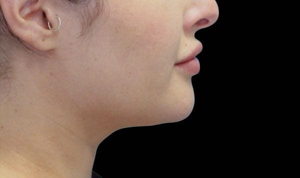 Treating Double Chins And Sagging Necks Dr Haus Dermatology