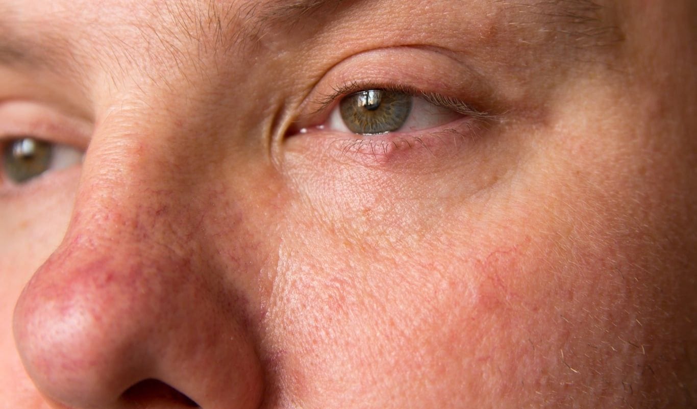 Broken Blood Vessels On Face And Nose Dr Haus Dermatology