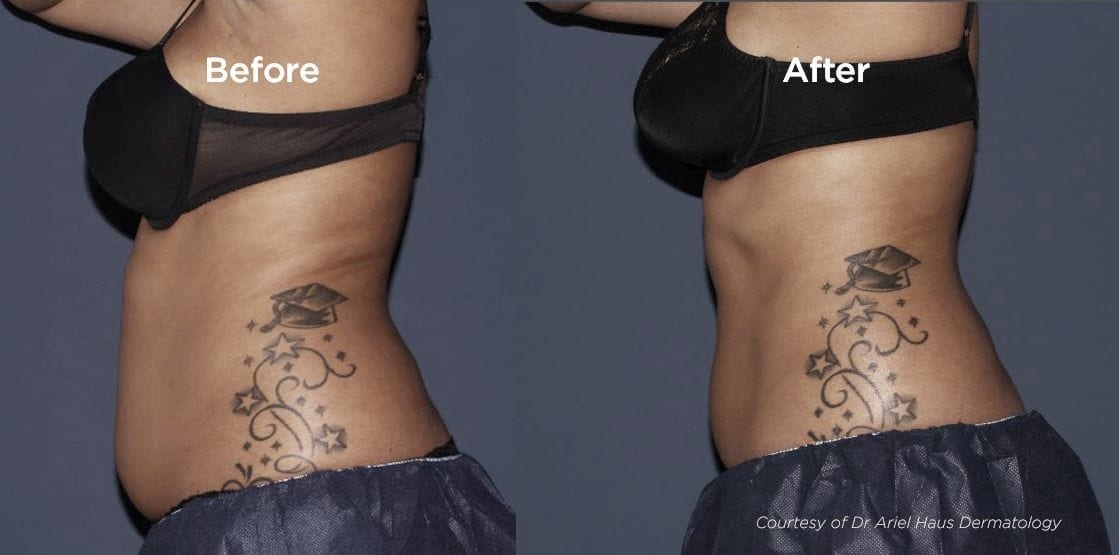 CoolSculpting Before and After London UK