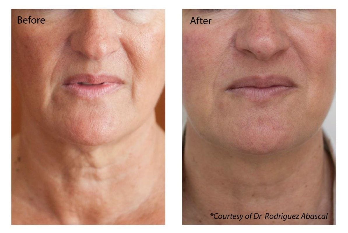 before and after Profhilo Treatment London