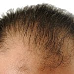 Hair Loss Treatment London - Dr. Ariel Haus