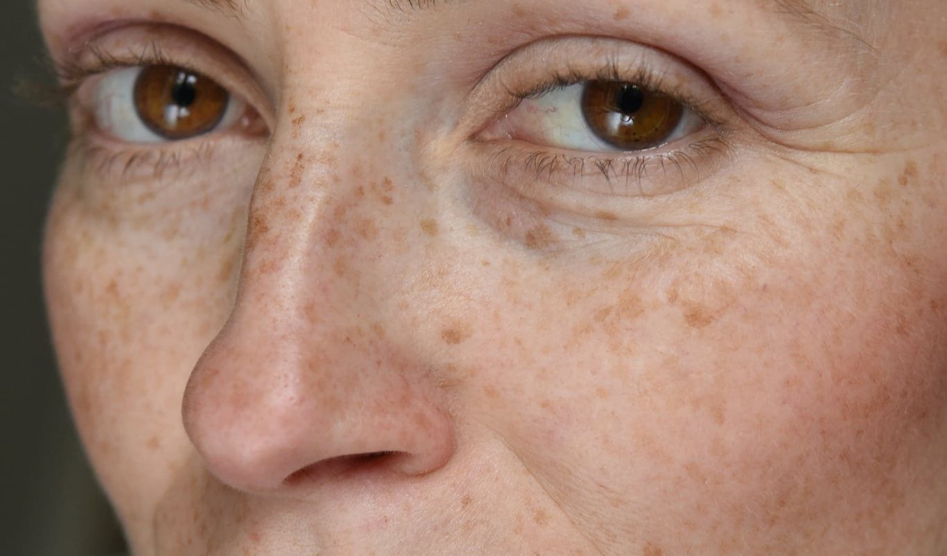 Treating Sun Damage and Sun Spots | Dr. Haus Dermatology