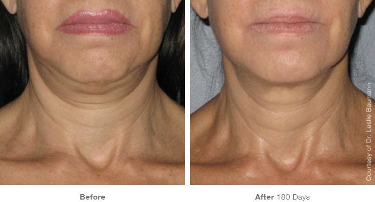 How to get rid online of saggy double chin