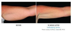 Reduce Arm Fat