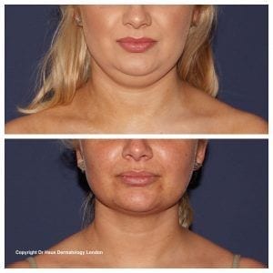 Coolsculpting fat freezing before and after photo.