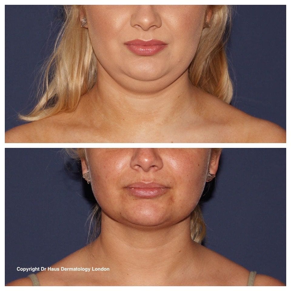 Double chin treatment London