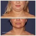 Double Chin Removal Before and After by Dr Haus Dermatology