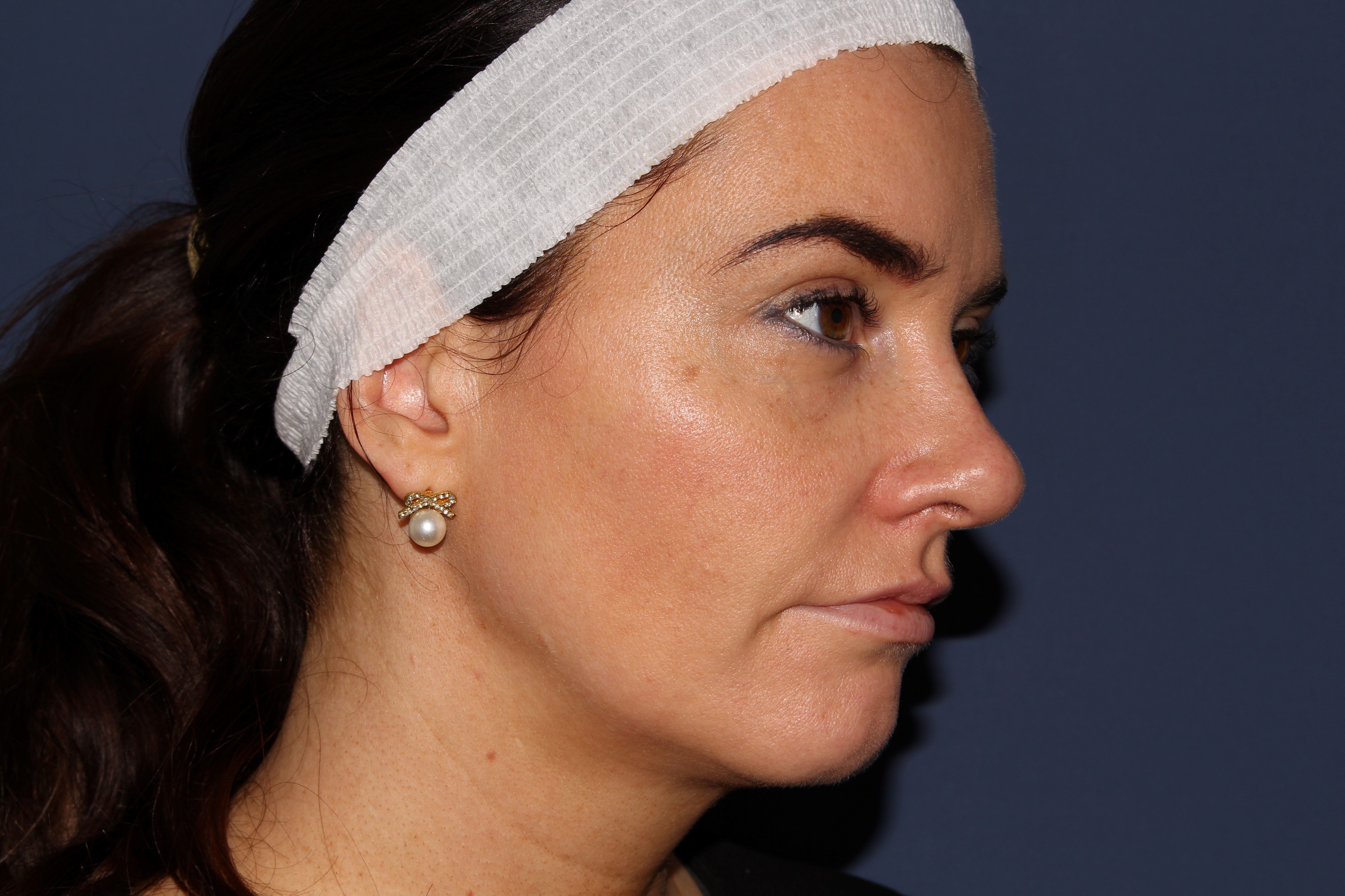 Dr Haus 5D Face Refresh New Laser Treatment Dr. Haus Dermatology