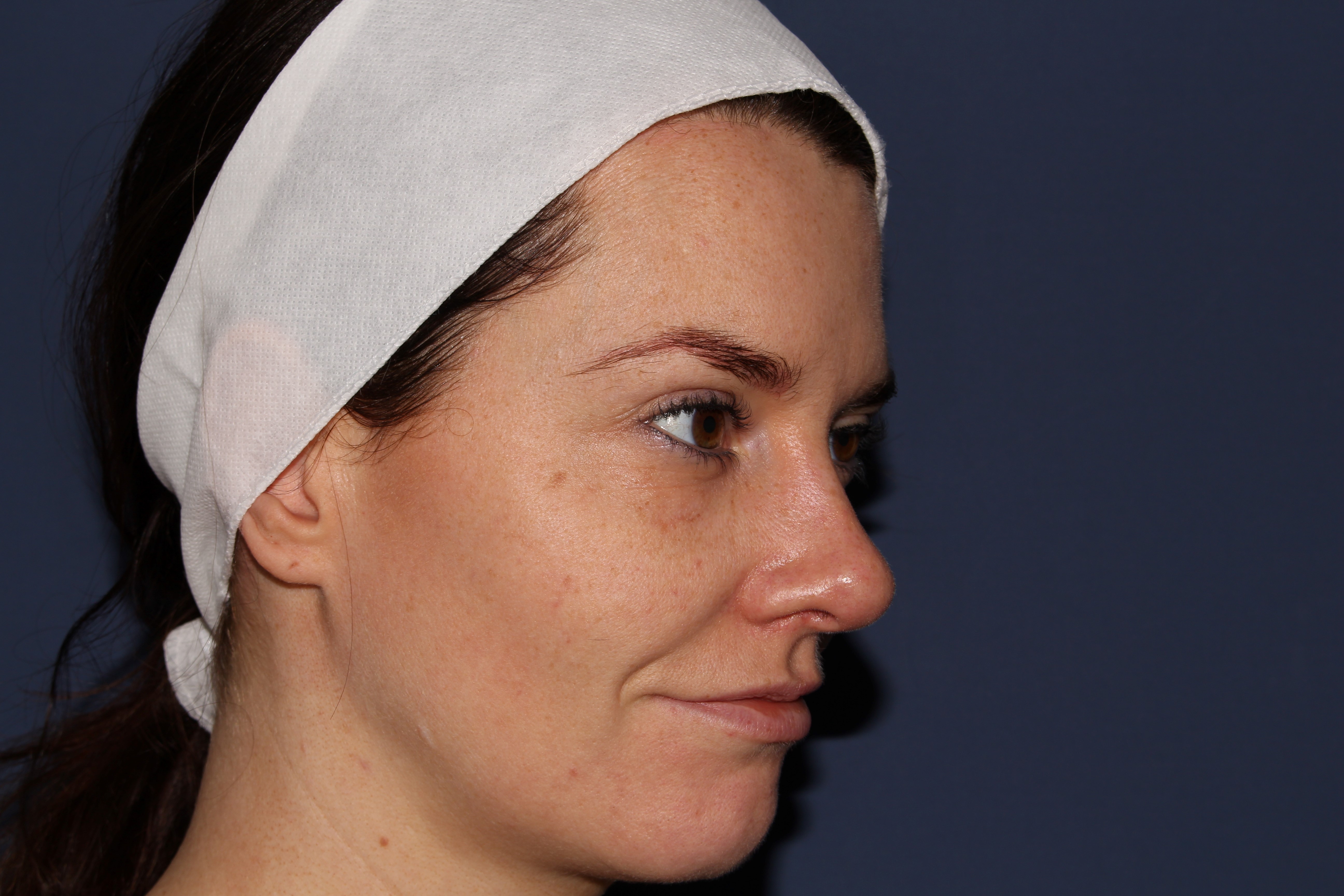 Dr Haus 5D Face Refresh New Laser Treatment Dr. Haus Dermatology