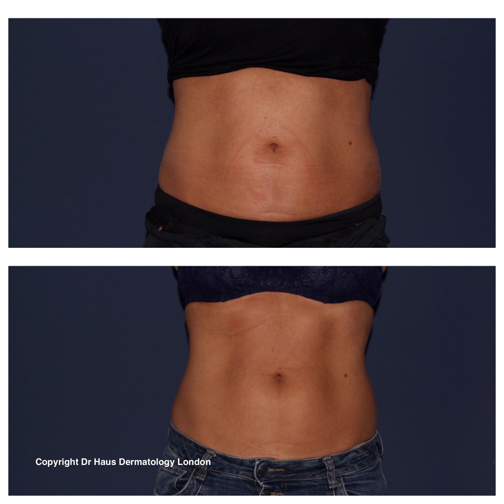 Emsculpt London before and after.