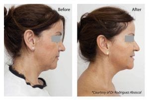 Profhilo Treatment London Before and After Dr Haus Dermatology
