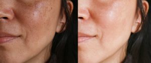 Melasma Treatment London Dr Haus Dermatology Harley Street