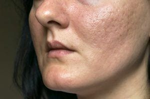 Acne Scar Removal London