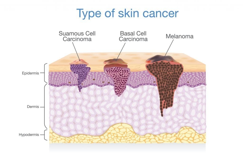Mole Removal London Mole Map Dr. Haus Dermatology