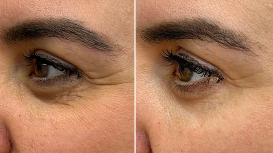 Polynucleotide Treatment around eyes before and after