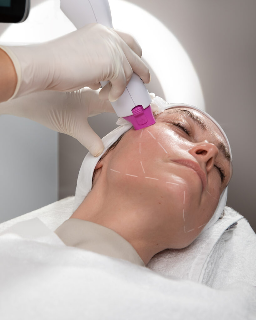 Thermage at Dr Haus Dermatology